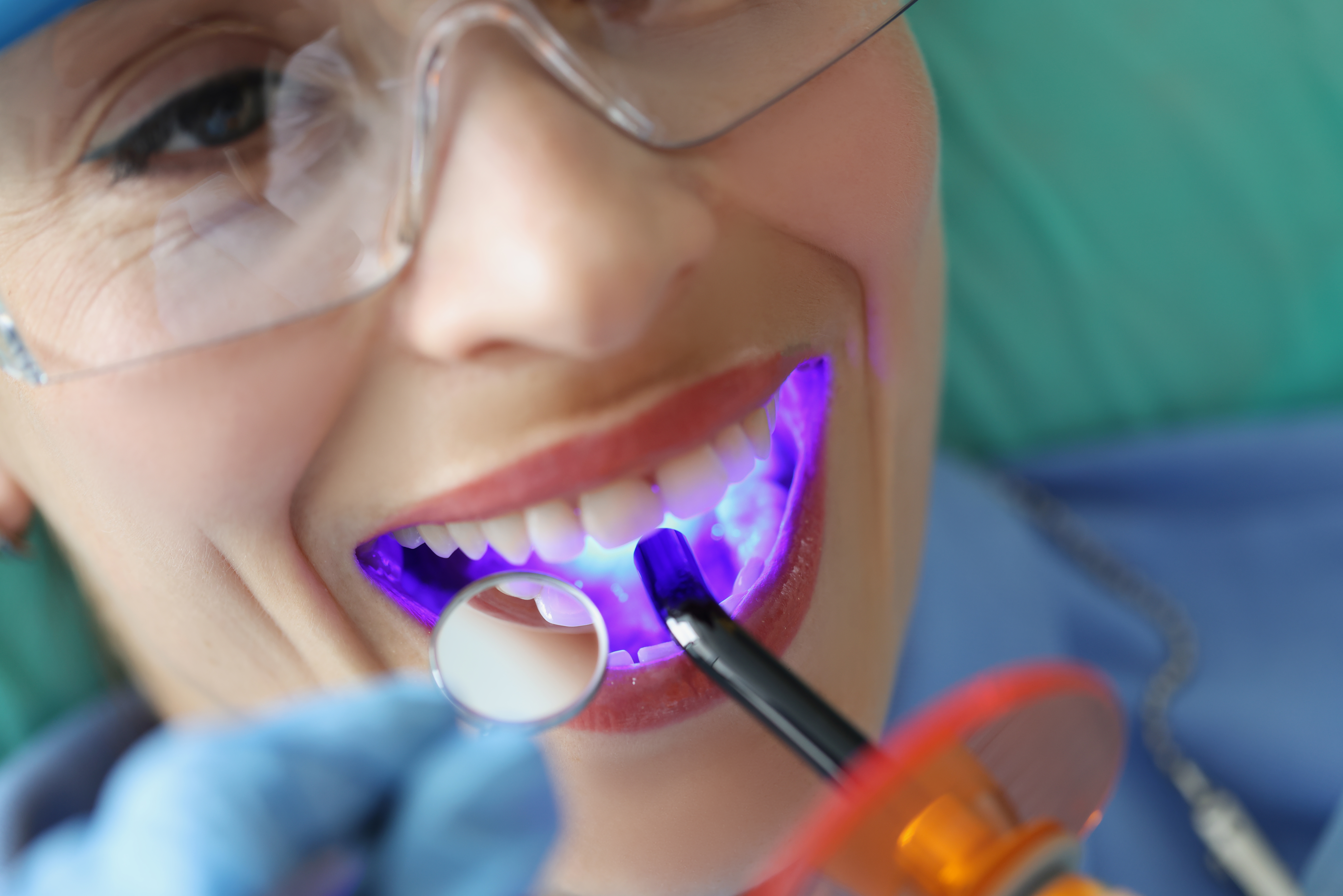 Dental sealants